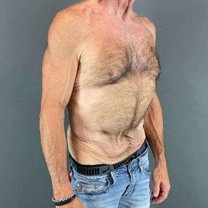 Gynecomastia Before & After Patient #642