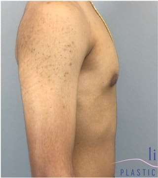 Gynecomastia Before & After Patient #653