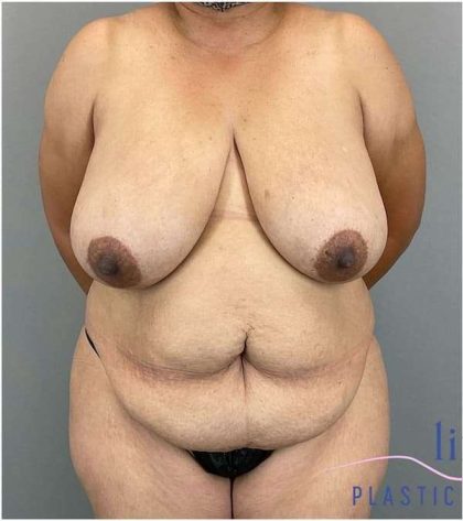 Breast Reduction Before & After Patient #664