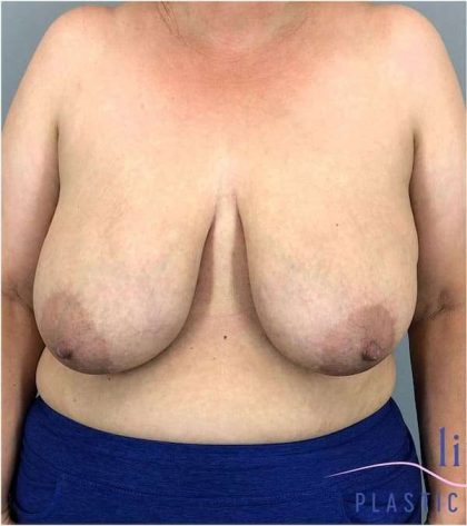 Breast Reduction Before & After Patient #675