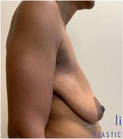 Breast Reduction Before & After Patient #686