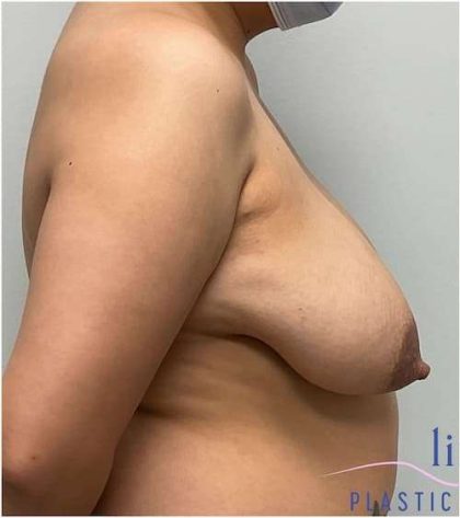 Breast Reduction Before & After Patient #697