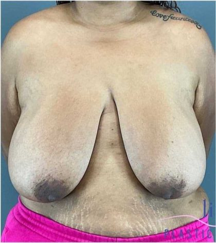 Breast Reduction Before & After Patient #708