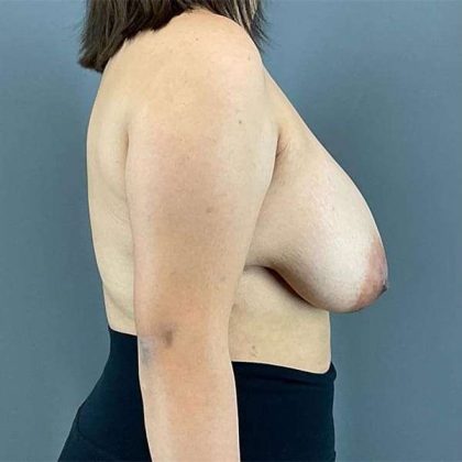 Breast Reduction Before & After Patient #719