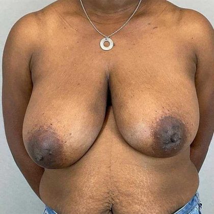 Breast Reduction Before & After Patient #730