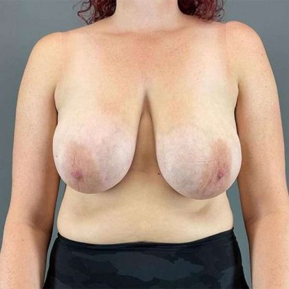 Breast Reduction Before & After Patient #741