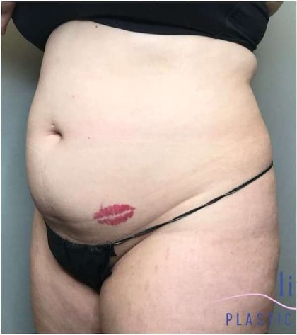 Liposuction Before & After Patient #166