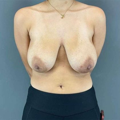 Breast Reduction Before & After Patient #752