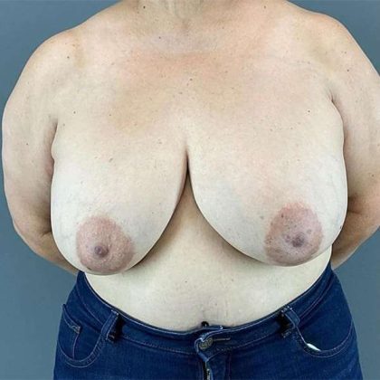 Breast Reduction Before & After Patient #763