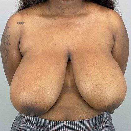 Breast Reduction Before & After Patient #774