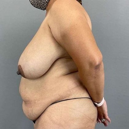 Breast Reduction Before & After Patient #785