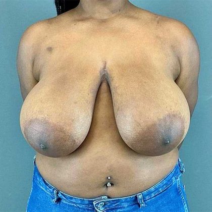 Breast Reduction Before & After Patient #810