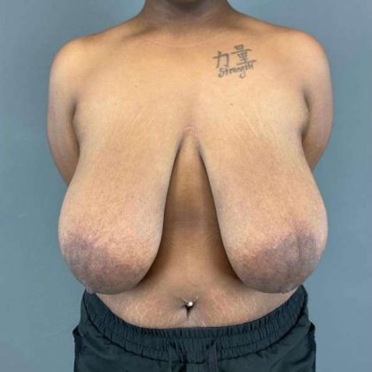 Breast Reduction Before & After Patient #828