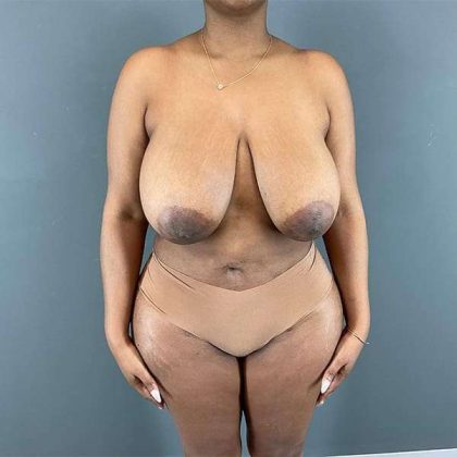 Breast Reduction Before & After Patient #839