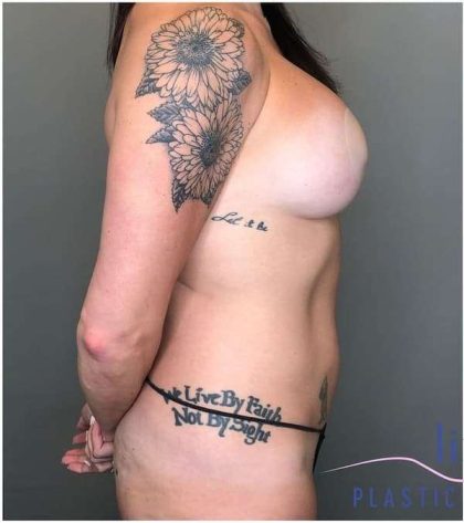 Bodytite Before & After Patient #269