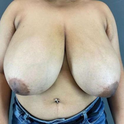 Breast Reduction Before & After Patient #850
