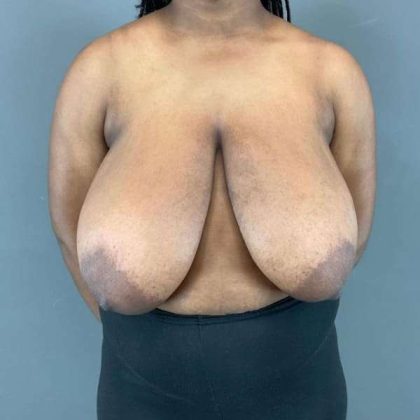 Breast Reduction Before & After Patient #861