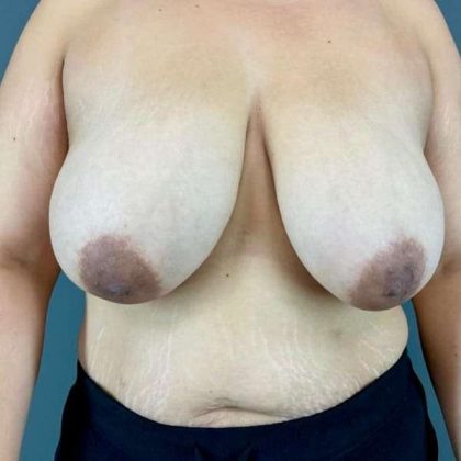 Breast Reduction Before & After Patient #872