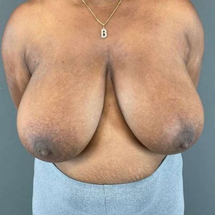 Breast Reduction Before & After Patient #883