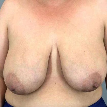 Breast Reduction Before & After Patient #894