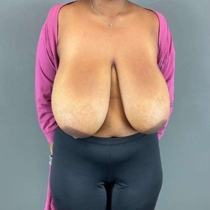 Breast Reduction Before & After Patient #905