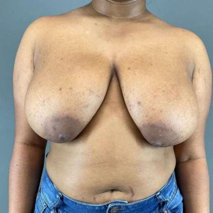 Breast Reduction Before & After Patient #916