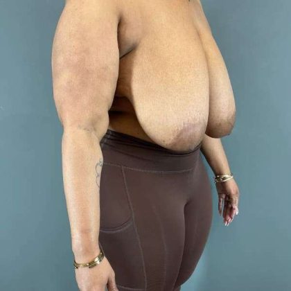 Breast Reduction Before & After Patient #927