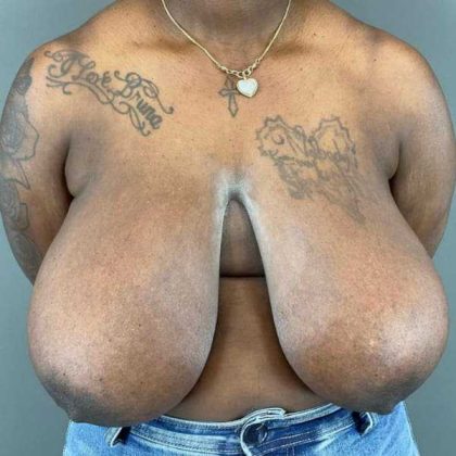 Breast Reduction Before & After Patient #938