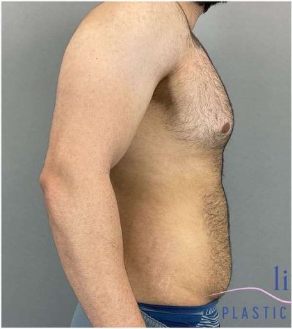 Bodytite Before & After Patient #280