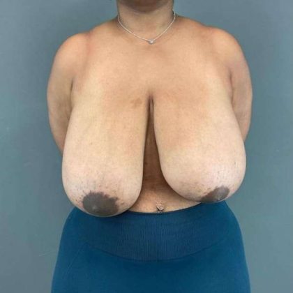 Breast Reduction Before & After Patient #967