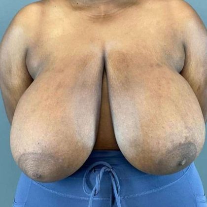 Breast Reduction Before & After Patient #978