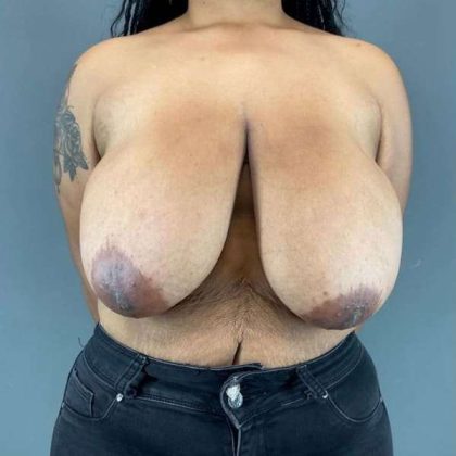 Breast Reduction Before & After Patient #998