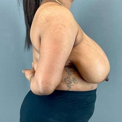 Breast Reduction Before & After Patient #1018