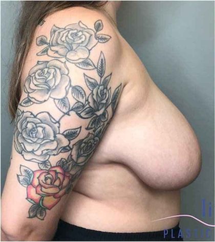 Breast Reduction Before & After Patient #1029