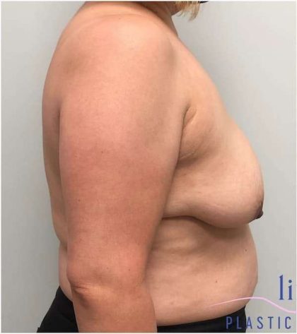 Breast Lift Before & After Patient #1040