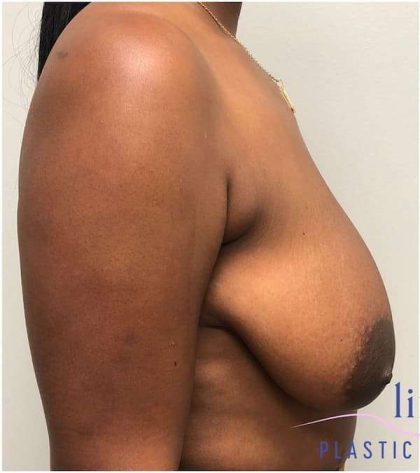 Breast Lift Before & After Patient #1051