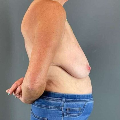 Breast Lift Before & After Patient #1062