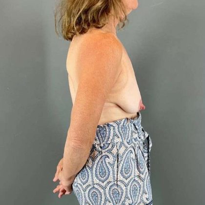 Breast Lift Before & After Patient #1073