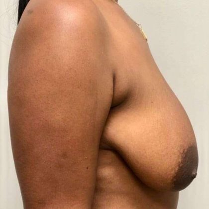 Breast Lift Before & After Patient #1084