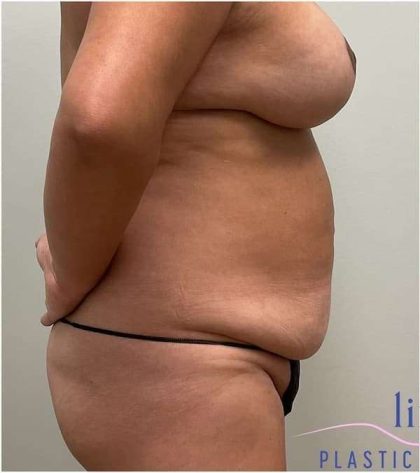 Tummy Tuck Before & After Patient #303