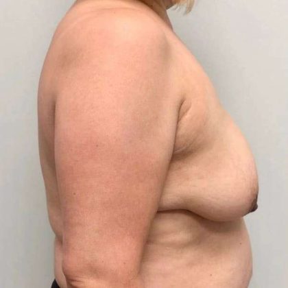 Breast Lift Before & After Patient #1120