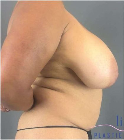 Breast Lift Before & After Patient #1131