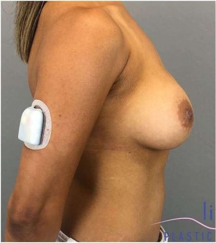 Breast Implant Exchange Before & After Patient #1164