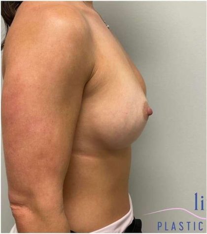 Breast Implant Exchange Before & After Patient #1186