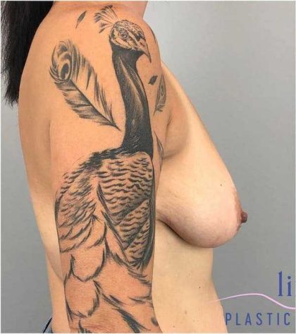 Breast Augmentation Before & After Patient #1197