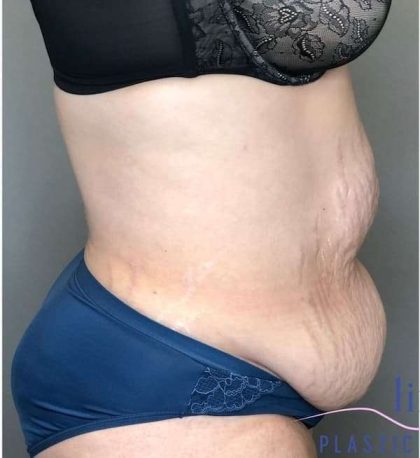 Tummy Tuck Before & After Patient #314