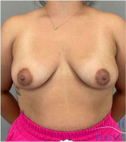 Breast Augmentation Before & After Patient #1230
