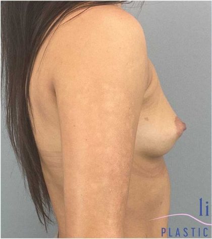 Breast Augmentation Before & After Patient #1252