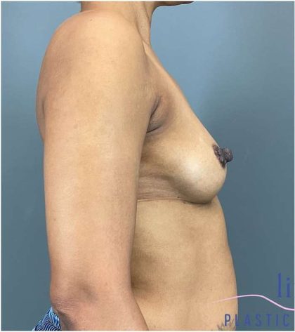Breast Augmentation Before & After Patient #1296