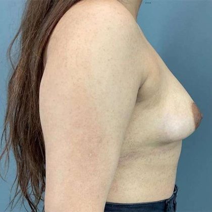 Breast Augmentation Before & After Patient #1318